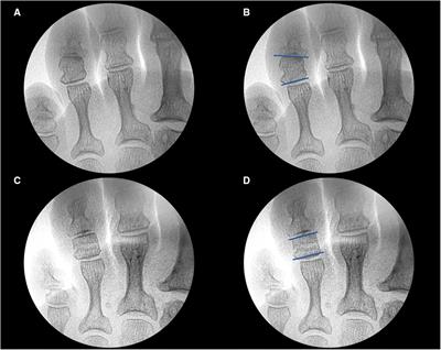 Effectiveness of minimally invasive surgery using incomplete phalangeal osteotomy for symptomatic curly toe of adults with a trapezoidal phalanx: An observational study